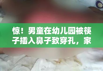 惊！男童在幼儿园被筷子插入鼻子致穿孔，家长直呼“离谱他妈给离谱开门”！